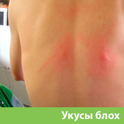 Укусы блох в Бронницах