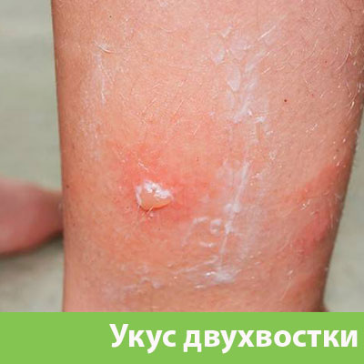 Укус двухвостки в Бронницах