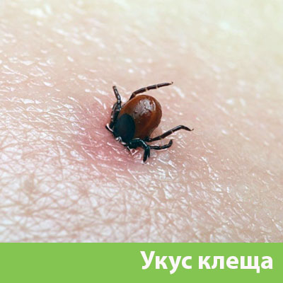 Укус клеща в Бронницах