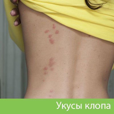 Профессиональное уничтожение клопов в Бронницах
